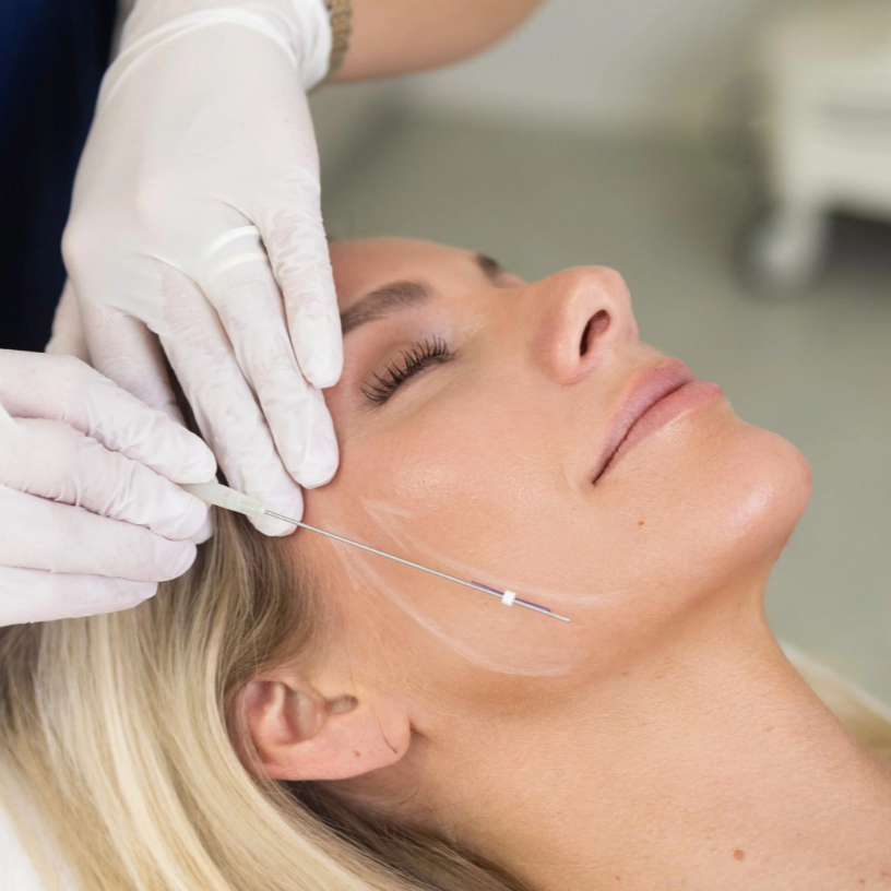 Non-Surgical Facial Lifting Threads: The Modern Alternative to Facelift Surgery