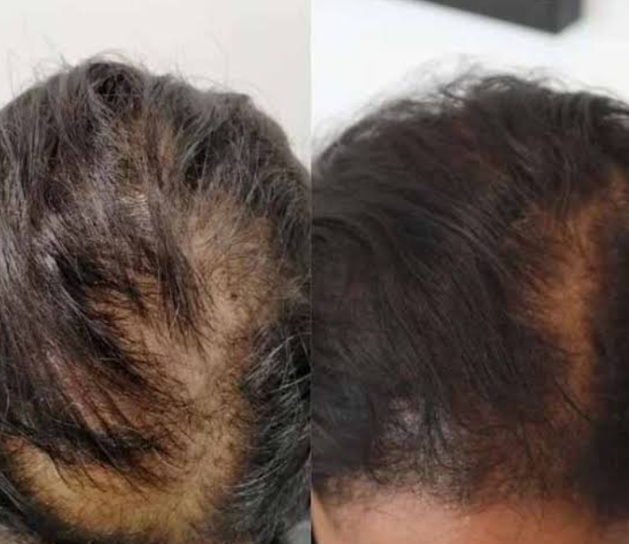 Exomide™ Scalp and Microneedling Therapy: A New Era in Hair Restoration and Scalp Health