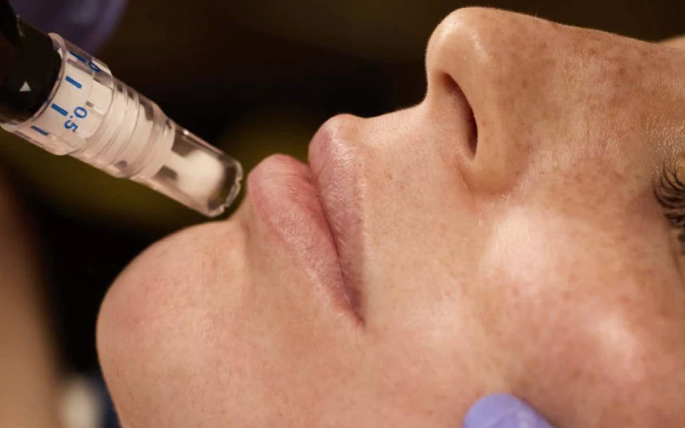 Skin pen being used on a woman's face
